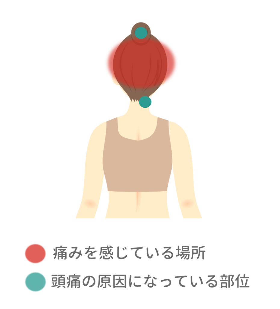 頭痛を感じている場所と原因となる部位を示す図