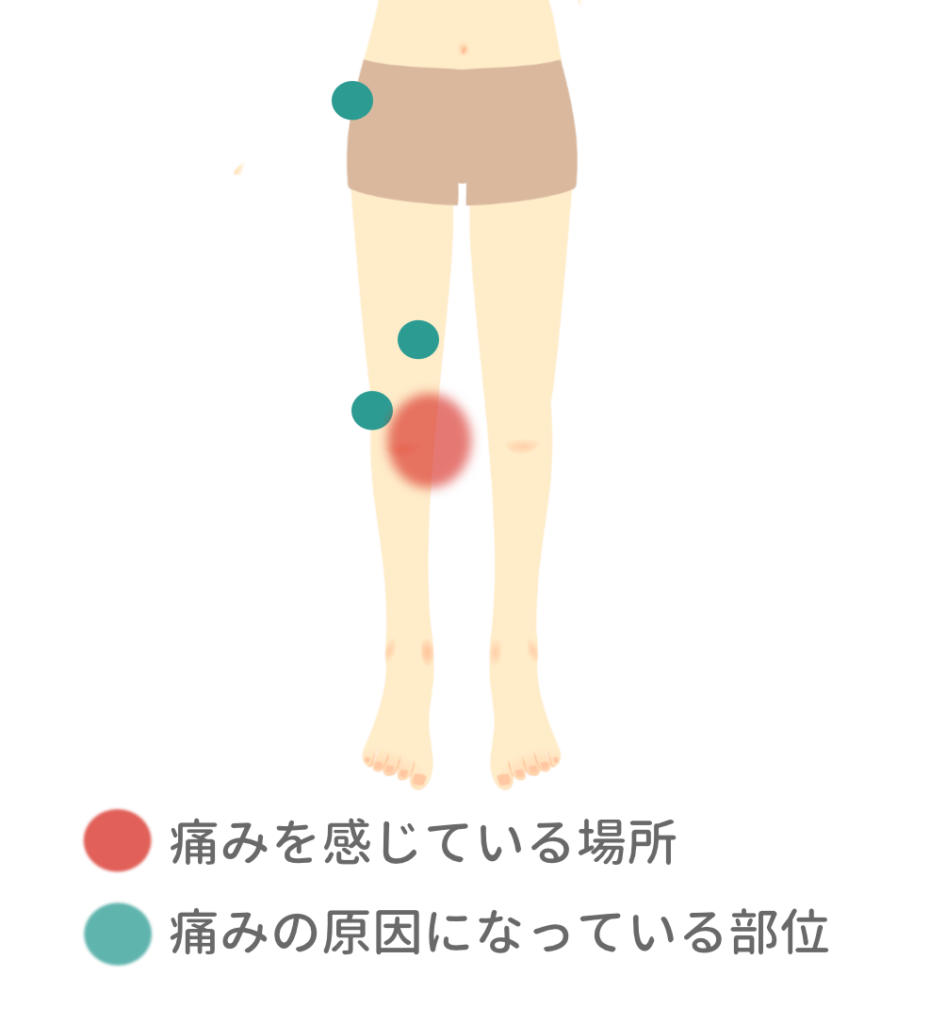 女性の下半身イラスト 膝に痛みを感じる場所を示す赤丸と腰や太ももに痛みの原因がある場所を示す青丸