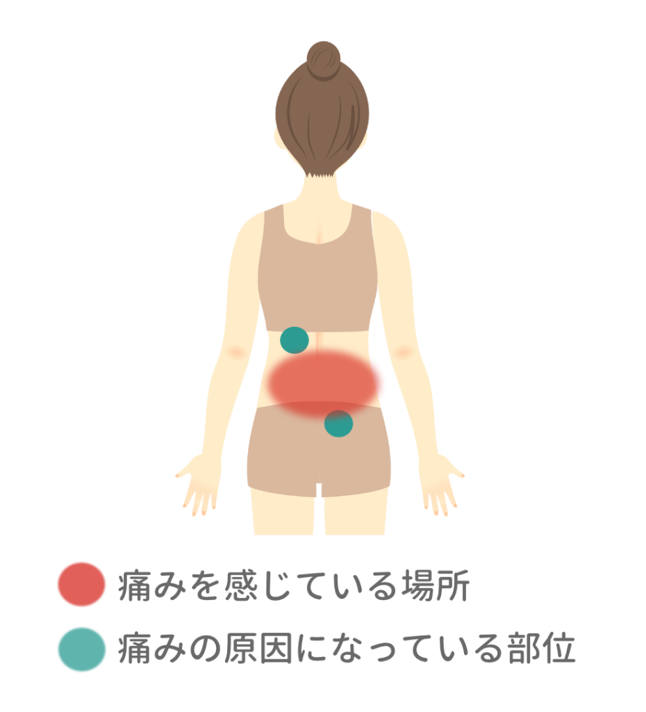 女性の腰の絵 痛みを感じている場所と痛みの原因になっている部位