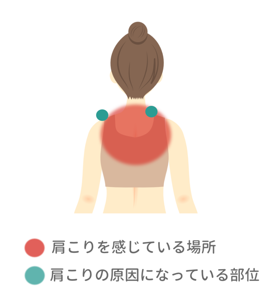 女性の首や肩が赤く塗られ肩こりを感じる場所青く塗られた肩の付け根が原因の部位を示したイラスト